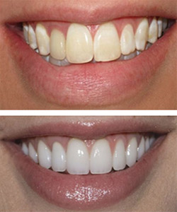 CERAMIC VENEERS