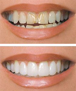 COMPOSITE VENEERS