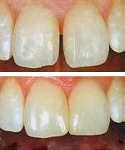 DIASTEMA CLOSURE