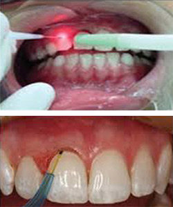 Laser Dentistry